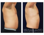Liposuction