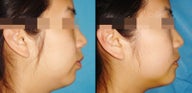 Chin Augmentation (Mentoplasty)