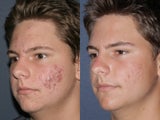 Photodynamic therapy and Fraxel Restore