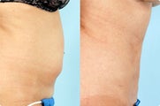 Smart Lipo: Abdomen
