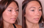 Rhinoplasty