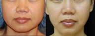 Asian Facial Slimming with Slim Lipo