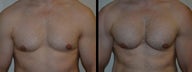 Male Treated for Lack of Chest Definition