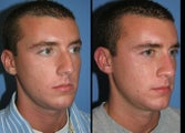 Rhinoplasty