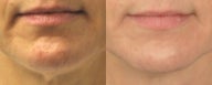 Tightening of the Neck with Sublative and ePrime combination treatment