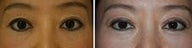 Before and After Asian Blepharoplasty for Eyelid Rejuvenation