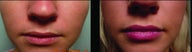 Restylane