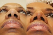 African Rhinoplasty Surgery. 1 month post-op.