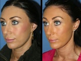 Revision Rhinoplasty