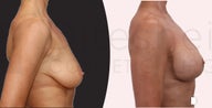 57 yr old woman, after weight loss, treated with augmentation mastopexy ( breast lift and implants)