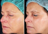 Fractional Laser Skin Resurfacing