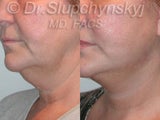 Minifacelift – Before and 10 Days After the SLUPlift 60 minute minifacelift