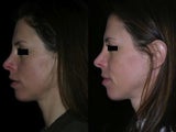 Juvederm and Radiesse