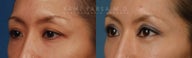 Before and After Upper and Lower Eyelid Blepharoplasty Surgery