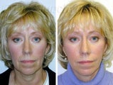 Facelift and Endoscopic Midfacelift