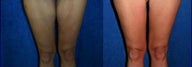 Thigh Lift after massive weight loss
