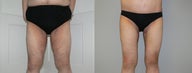 Inner thigh lift after massive weight loss