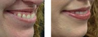 Gummy Smile Correction
