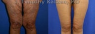 Thigh Lift after massive weight loss