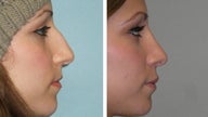 Deviation Correction and Cosmetic Rhinoplasty Together
