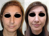 SLUPlift minifacelift procedure