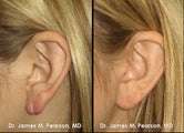 Torn Earlobe Repair