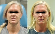 Cheek Augmentation and Botox
