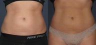CoolSculpting Before and After Photo