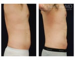 Liposuction