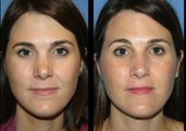 Revision Rhinoplasty
