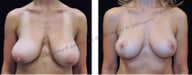 Breast Lift