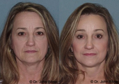 Laser Skin Resurfacing