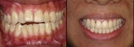 Braces to treat openbite and crowding