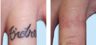 Tattoo Laser