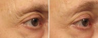 Ulthera Laser Skin Tightening