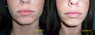 Lip augmentation with 1 syringe of Juvederm