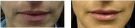 Filler for Fuller Lips