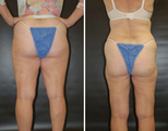 Thigh Lift