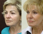 72 years old with facial and eyelid sagging