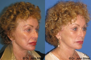 Brow Lift