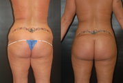 Brazilian Butt Lift