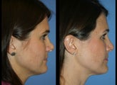 Revision Rhinoplasty