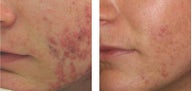 Acne Treatment