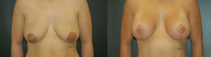Breast Lift and Augmentation