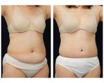 Liposuction