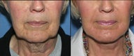 Facelift with Implants and Perioral Resurfacing