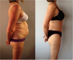 Abdominoplasty / Tummy Tuck Before & After