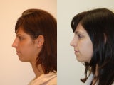 Rhinoplasty Surgery. 7-years post-op.