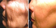 Before and After No Down Time 1540 Erbium Laser Resurfacing for Wrinkle Removal