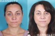 Revision Rhinoplasty